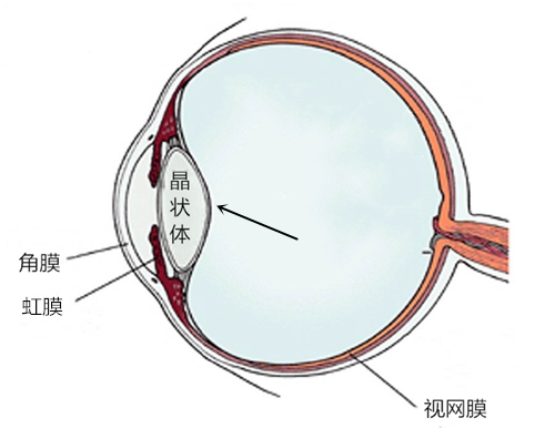 白內障,?，斎鹨曆劭?上海眼科醫(yī)院