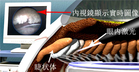 青光眼,?，斎鹨曆劭?上海眼科醫(yī)院