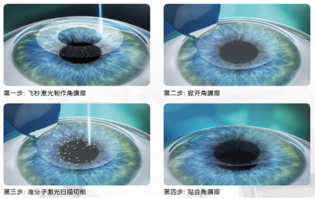 屈光矯視,?，斎鹨曆劭?上海眼科醫(yī)院