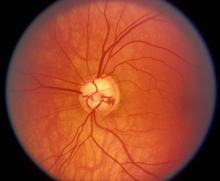 青光眼,?，斎鹨曆劭?上海眼科醫(yī)院