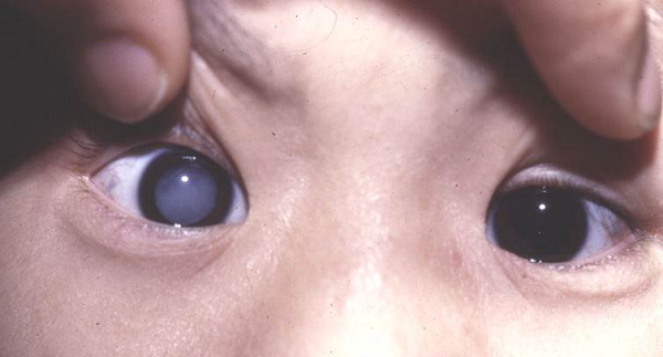 白內(nèi)障,?，斎鹨曆劭?上海眼科醫(yī)院