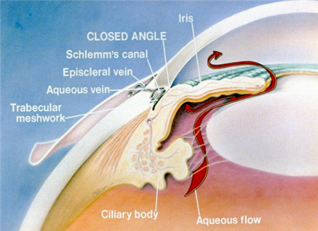 青光眼,?，斎鹨曆劭?上海眼科醫(yī)院