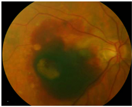 玻璃體視網(wǎng)膜,?，斎鹨曆劭?上海眼科醫(yī)院