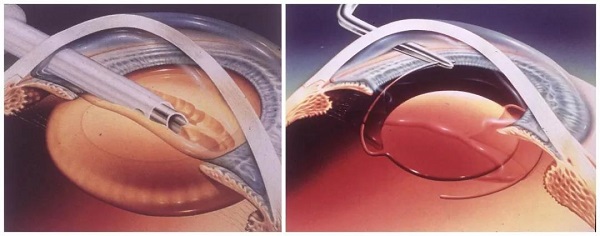 白內(nèi)障,?，斎鹨曆劭?上海眼科醫(yī)院