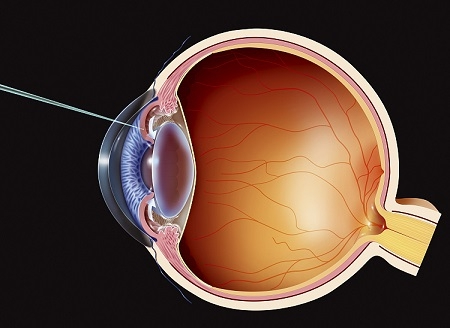 青光眼,希瑪瑞視眼科,上海眼科醫(yī)院