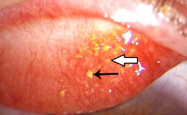眼表眼角膜,?，斎鹨曆劭?上海眼科醫(yī)院