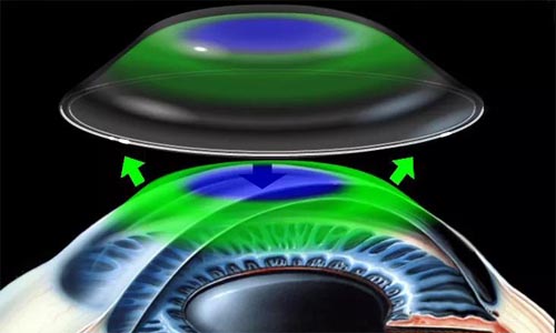 醫(yī)學(xué)驗(yàn)光配鏡,?，斎鹨曆劭?上海眼科醫(yī)院