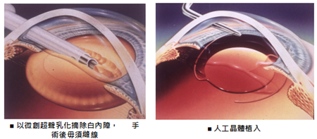 白內(nèi)障,?，斎鹨曆劭?上海眼科醫(yī)院