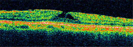 玻璃體視網(wǎng)膜,?，斎鹨曆劭?上海眼科醫(yī)院