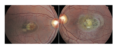 小兒眼病,希瑪瑞視眼科,上海眼科醫(yī)院