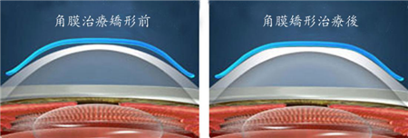 屈光矯視,?，斎鹨曆劭?上海眼科醫(yī)院