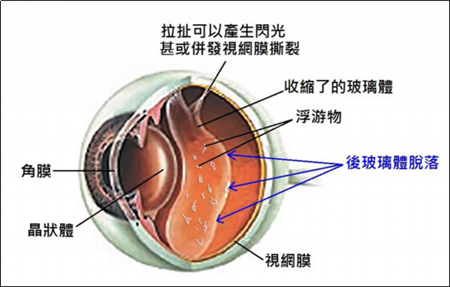 玻璃體視網(wǎng)膜,?，斎鹨曆劭?上海眼科醫(yī)院