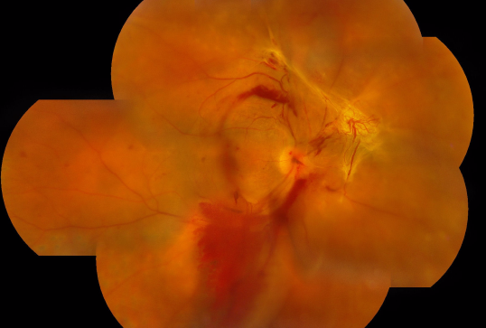 玻璃體視網(wǎng)膜,?，斎鹨曆劭?上海眼科醫(yī)院