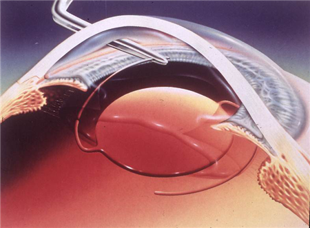 白內(nèi)障,?，斎鹨曆劭?上海眼科醫(yī)院