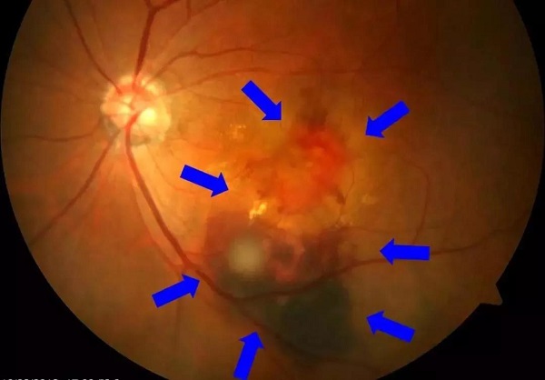 玻璃體視網(wǎng)膜,?，斎鹨曆劭?上海眼科醫(yī)院