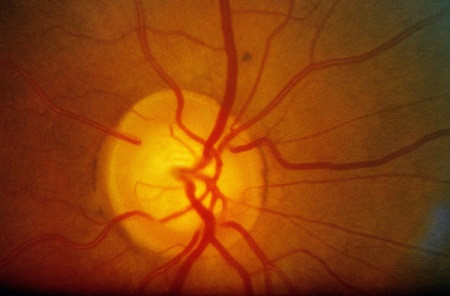 青光眼,?，斎鹨曆劭?上海眼科醫(yī)院