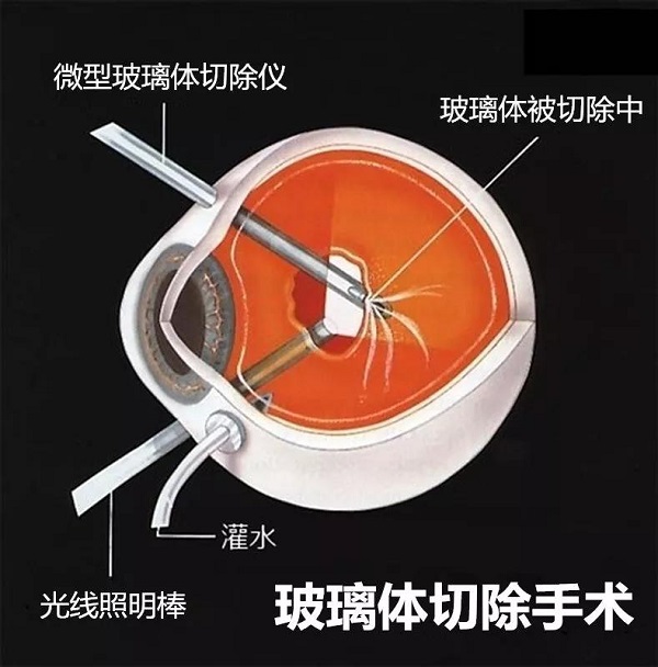 玻璃體視網(wǎng)膜,?，斎鹨曆劭?上海眼科醫(yī)院