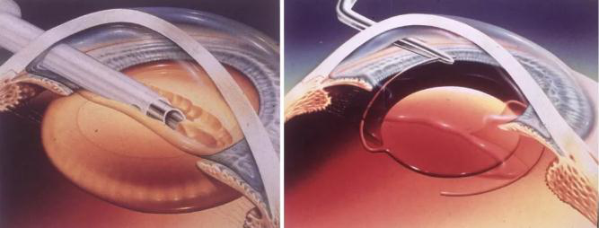 白內(nèi)障,希瑪瑞視眼科,上海眼科醫(yī)院