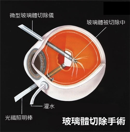 玻璃體視網(wǎng)膜,?，斎鹨曆劭?上海眼科醫(yī)院