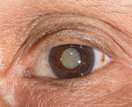 白內(nèi)障,?，斎鹨曆劭?上海眼科醫(yī)院