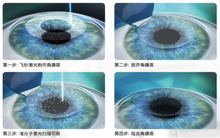 屈光矯視,?，斎鹨曆劭?上海眼科醫(yī)院