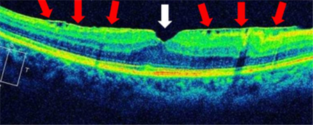 玻璃體視網(wǎng)膜,?，斎鹨曆劭?上海眼科醫(yī)院