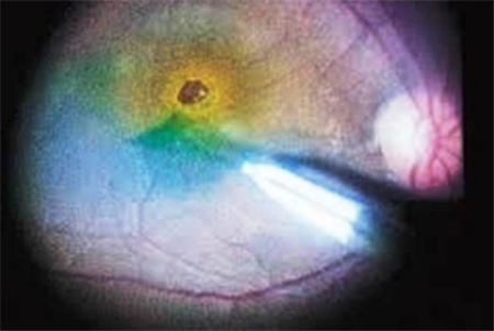 玻璃體視網(wǎng)膜,?，斎鹨曆劭?上海眼科醫(yī)院