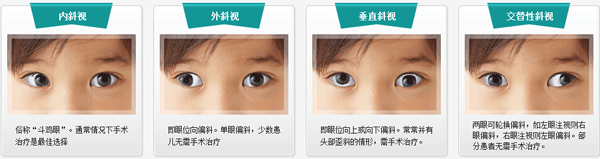 小兒眼病,?，斎鹨曆劭?上海眼科醫(yī)院