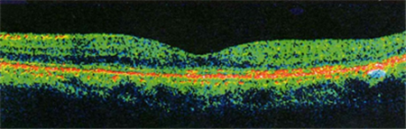 玻璃體視網(wǎng)膜,?，斎鹨曆劭?上海眼科醫(yī)院