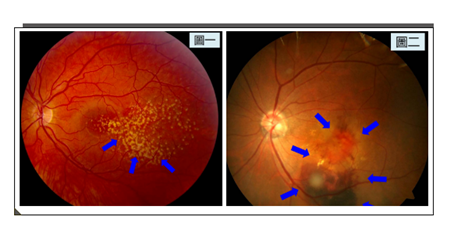 玻璃體視網(wǎng)膜,?，斎鹨曆劭?上海眼科醫(yī)院