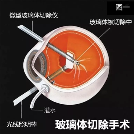 玻璃體視網(wǎng)膜,?，斎鹨曆劭?上海眼科醫(yī)院