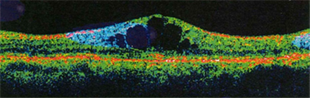 玻璃體視網(wǎng)膜,?，斎鹨曆劭?上海眼科醫(yī)院
