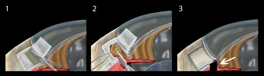 青光眼,?，斎鹨曆劭?上海眼科醫(yī)院