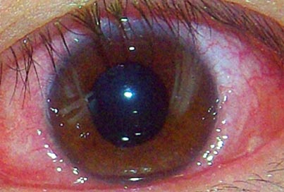 眼表眼角膜,?，斎鹨曆劭?上海眼科醫(yī)院