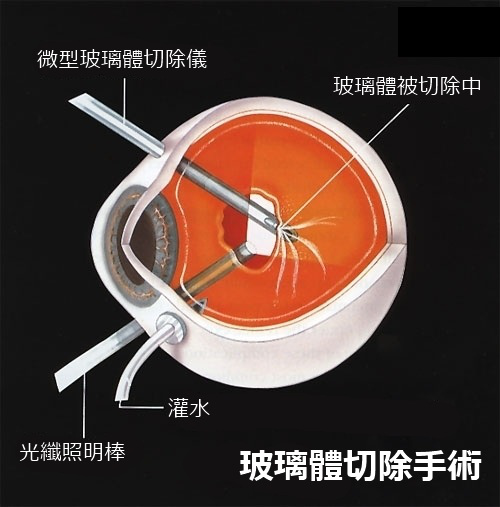 玻璃體視網(wǎng)膜,?，斎鹨曆劭?上海眼科醫(yī)院