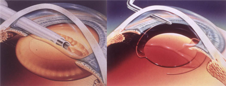 白內(nèi)障,?，斎鹨曆劭?上海眼科醫(yī)院