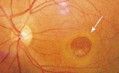 玻璃體視網(wǎng)膜,?，斎鹨曆劭?上海眼科醫(yī)院