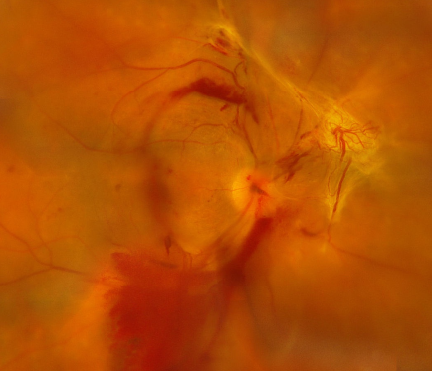 青光眼,?，斎鹨曆劭?上海眼科醫(yī)院