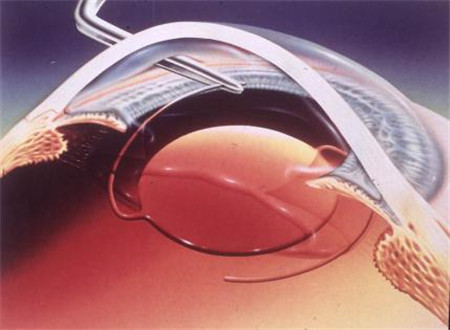 白內(nèi)障,?，斎鹨曆劭?上海眼科醫(yī)院