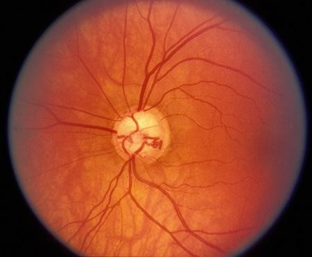 青光眼,?，斎鹨曆劭?上海眼科醫(yī)院