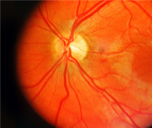 玻璃體視網(wǎng)膜,?，斎鹨曆劭?上海眼科醫(yī)院