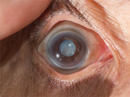 白內(nèi)障,?，斎鹨曆劭?上海眼科醫(yī)院