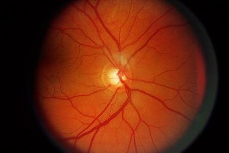 青光眼,?，斎鹨曆劭?上海眼科醫(yī)院