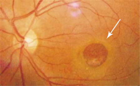 玻璃體視網(wǎng)膜,?，斎鹨曆劭?上海眼科醫(yī)院