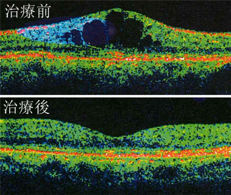 玻璃體視網(wǎng)膜,?，斎鹨曆劭?上海眼科醫(yī)院
