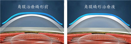 屈光矯視,?，斎鹨曆劭?上海眼科醫(yī)院