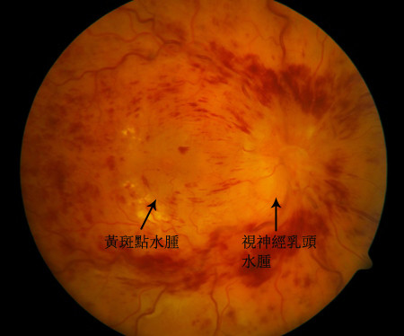 玻璃體視網(wǎng)膜,?，斎鹨曆劭?上海眼科醫(yī)院