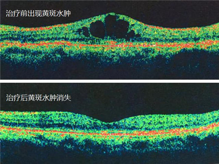 玻璃體視網(wǎng)膜,?，斎鹨曆劭?上海眼科醫(yī)院