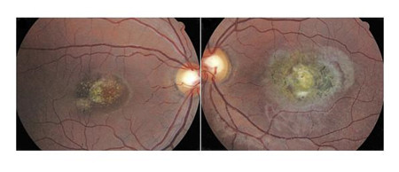 小兒眼病,?，斎鹨曆劭?上海眼科醫(yī)院