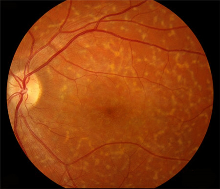 玻璃體視網(wǎng)膜,?，斎鹨曆劭?上海眼科醫(yī)院